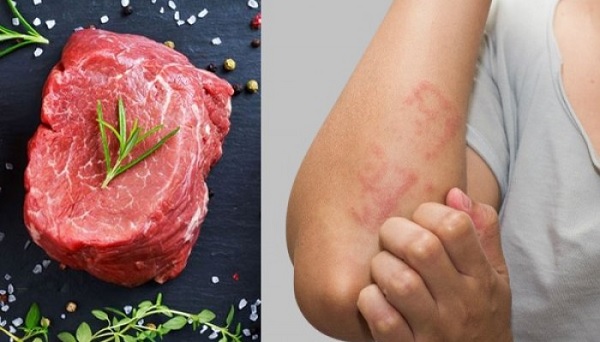 Các đối tượng ăn thịt bò bị dị ứng gây ảnh hưởng nghiêm trọng đến sức khỏe