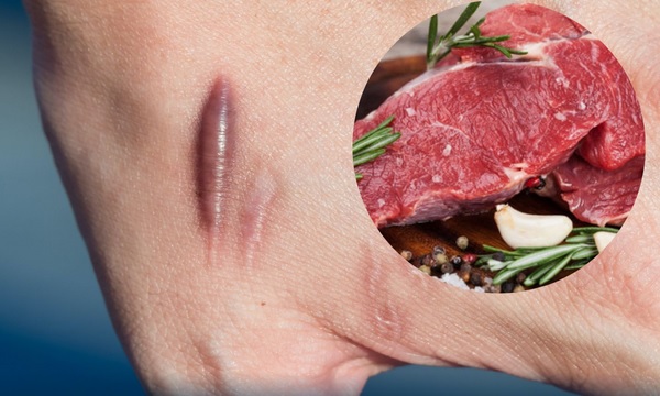 Không ăn thịt bò khi đang điều trị vết thương hở